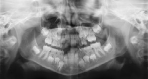 Dental Radiographs (X-Rays) - Pediatric Dentist in Hales Corners, WI