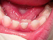 Baby Teeth - Pediatric Dentist in Hales Corners, WI